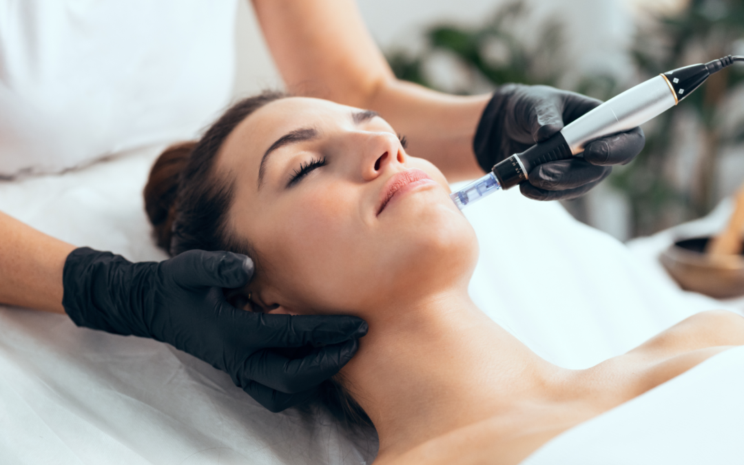 Microneedling RF : Réduire les cicatrices d’acné en seulement 4 mois