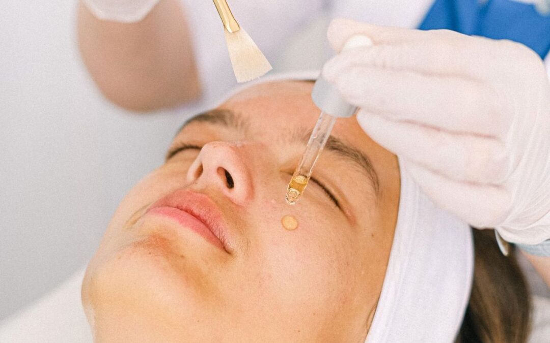 Les peelings chimiques peuvent-ils améliorer l’apparence des cicatrices d’acné?