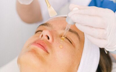 Can Chemical Peels Help Improve Acne Scars?