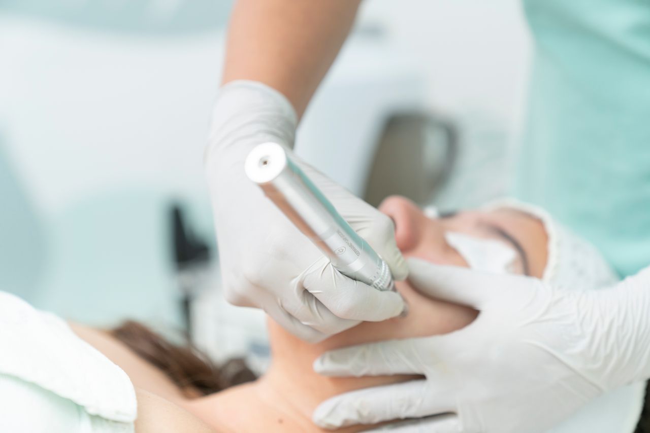Microdermabrasion